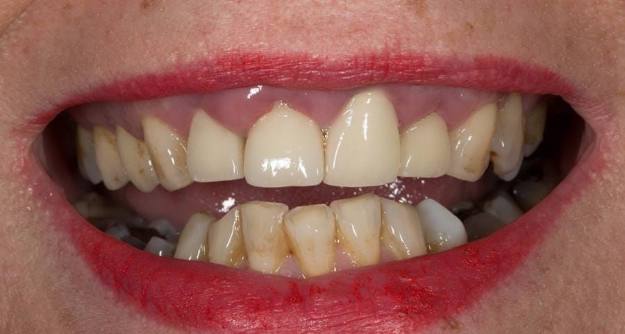 Figure 2. Pre-treatment showing high smile line and aesthetically poor upper incisors