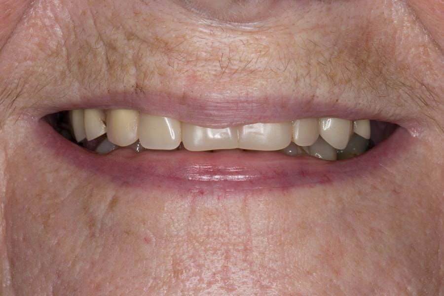 Figure 2. Pre-treatment with poorly fitting cobalt chromium based maxillary partial denture