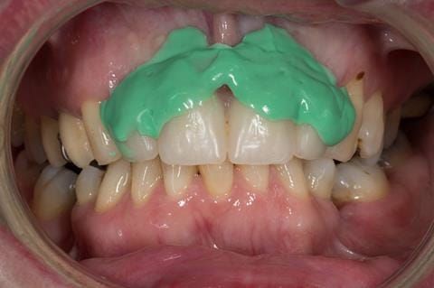 Figure 52. Immediate denture laboratory reline - part 1 with light bodied silicone impression material (Doric Flo light - Schottlander).