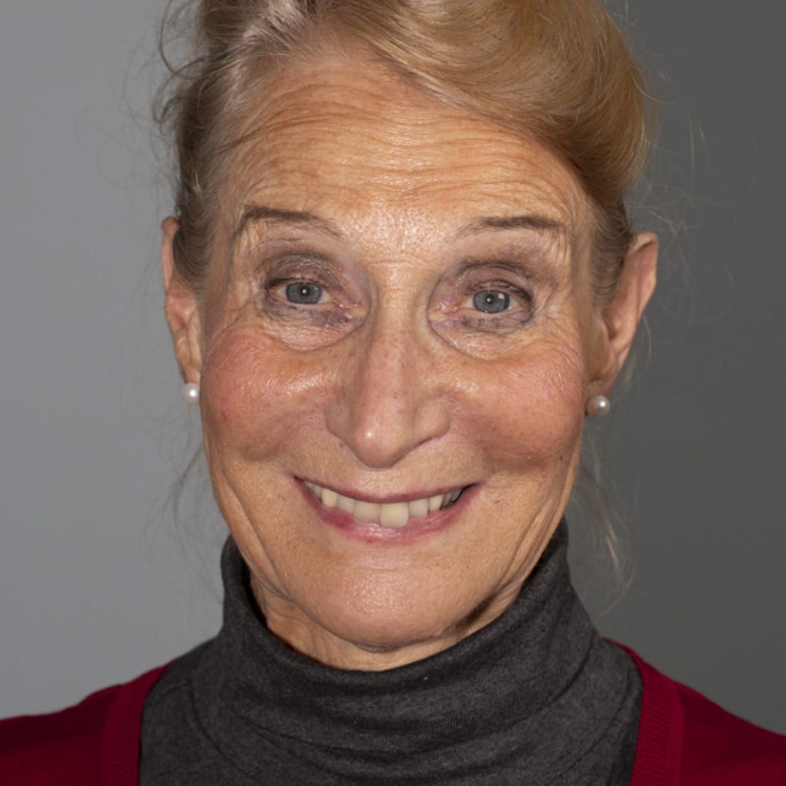 Implant Overdentures