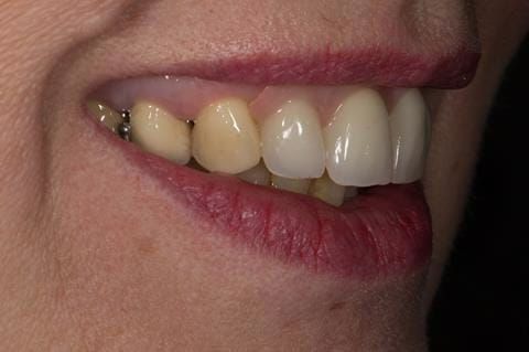 Figure 69. Immediate denture at 11 months post extraction. Ready to start making definitive cobalt chromium based partial denture.