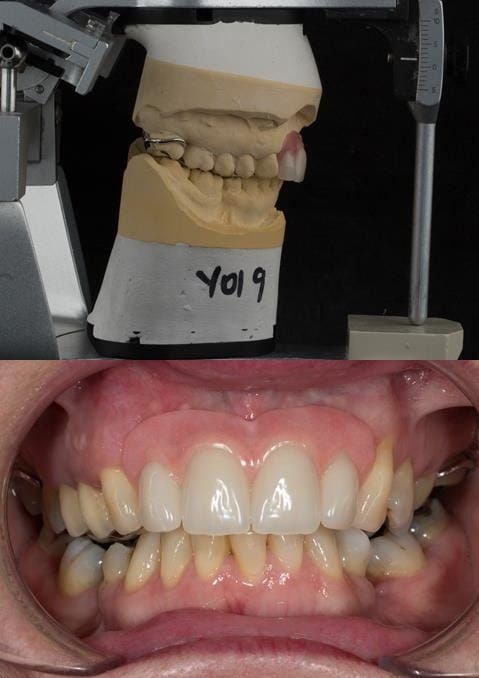 Figure 111. Fitted cobalt chromium based maxillary partial denture replacing upper 2-2 in intercuspal position. Schottlander Enigmalife teeth.