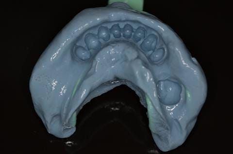 Figure 19. Visit 1. Mandibular impression made in alginate for opposing model.