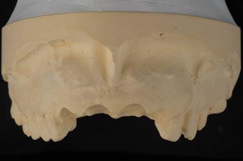 Figure 21. Primary cast of the maxillary arch with upper incisors removed and prepared for ovate pontics.