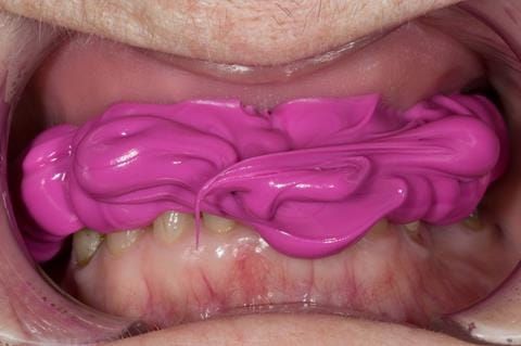 Figure 45. Visit - 3 Central bearing apparatus fixed together with Futar D.
