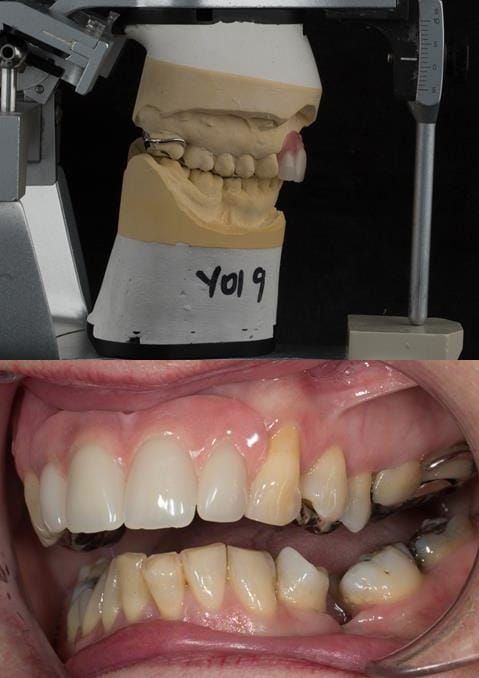 Figure 117. Fitted cobalt chromium based maxillary partial denture with teeth apart. Schottlander Enigmalife teeth.