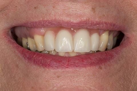Figure 50. Chair-side reline appointment - 3 months after extractions. The Ufi gel Hard - Voco has been polished and denture fitted. A laboratory reline was scheduled for 5 months post extraction.
