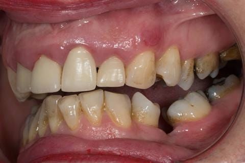Figure 10. Pre-treatment - upper four incisors with inflammation of the gingivae and mis-match of the gingival levels.