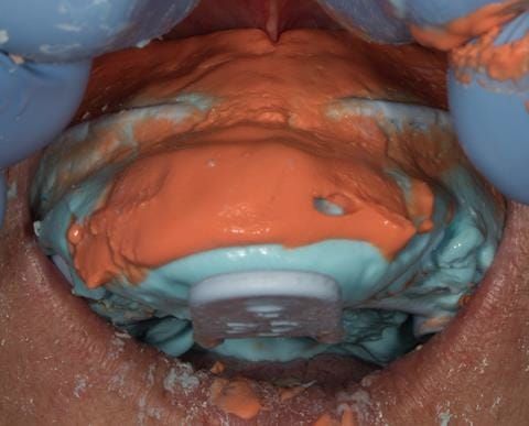 Figure 16. Maxillary primary impression made in two stages using Accudent XD, Ivoclar. This allows full extension to record the sulcus.