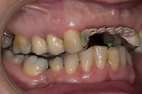Figure 98. Maxillary cobalt chromium framework trial insertion, checking the occlusion.