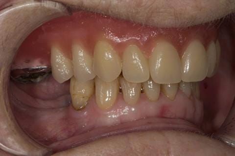 Figure 57. Visit 4 Teeth wax try in with Schottlander Enigmalife teeth in mouth in centric relation position.