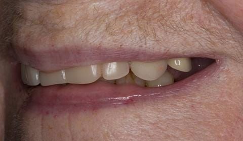 Figure 4. Pre-treatment with poorly fitting cobalt chromium based maxillary partial denture