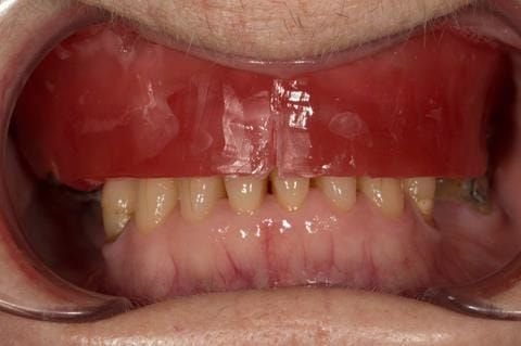 Figure 39. Visit 3 - maxillary wax rim carved with reference to photos - figures 14 and 15. Please note this is only for tooth position prescription and occlusal vertical dimension. The central bearing apparatus records centric relation.
