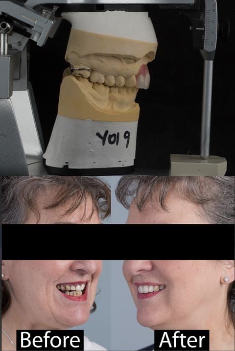 Figure 123. Before and after provision of a cobalt chromium based maxillary partial denture replacing upper 2-2.
