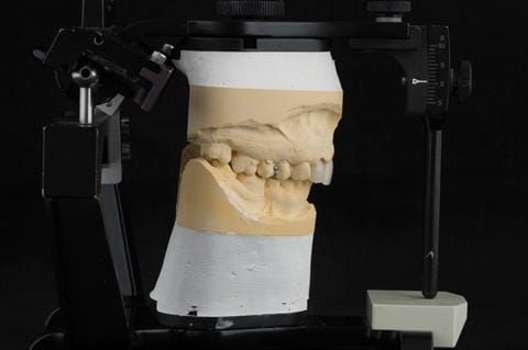 Figure 25. Maxillary immediate partial denture finished with ovate pontics and ball ended clasps on Denar Mk 2 articulator.