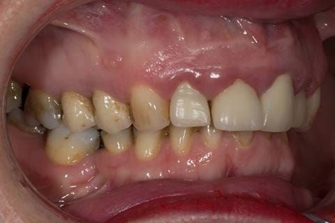 Figure 7. Pre-treatment - upper four incisors with inflammation of the gingivae and mis-match of the gingival levels.