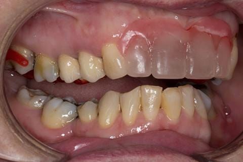 Figure 78. Pattern resin mock up fitted for patient to assess future visible metal. The patient was happy to proceed with the definitive denture design as per Figure 15.