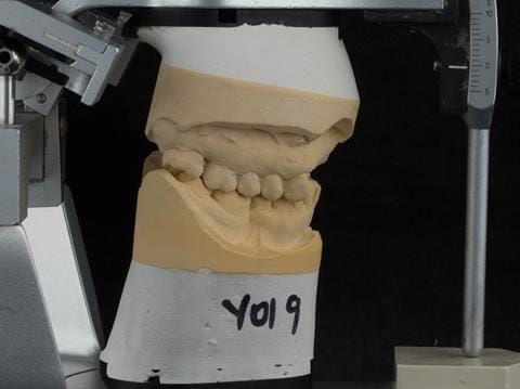 Figure 104. Definitive cast on Denar Mk 2 articulator - maxillary cast mounted using facebow transfer and mandibular cast mounted in intercuspal position.