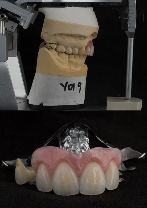 Figure 128. Cobalt chromium based maxillary partial denture from a different case of similar design. The upper right first premolar required removal at a later date. Dental bar designed using a laser welded tag to support the artificial tooth.