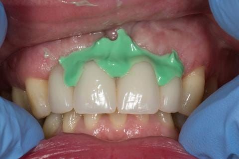 Figure 44. Chair-side reline appointment - 3 months after extractions. Space check with light bodied silicone impression material (Doric Flo light - Schottlander) - indicating how much chair-side reline to use.