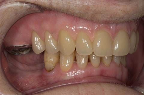 Figure 76. Visit 5 Fitted definitive denture - Schottlander Enigmalife teeth