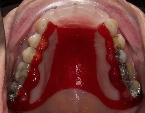 Figure 77. Pattern resin mock up fitted for patient to assess future visible metal.