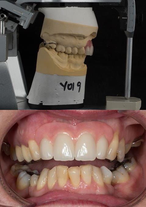 Figure 109. Fitted cobalt chromium based maxillary partial denture replacing upper 2-2 with teeth apart. Schottlander Enigmalife teeth.