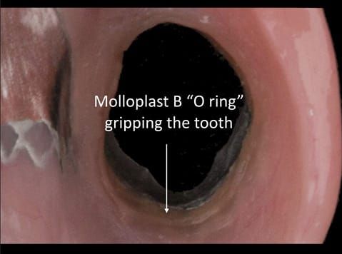 Figure 67. Definitive denture finished with Molloplast B "O" ring around UR7