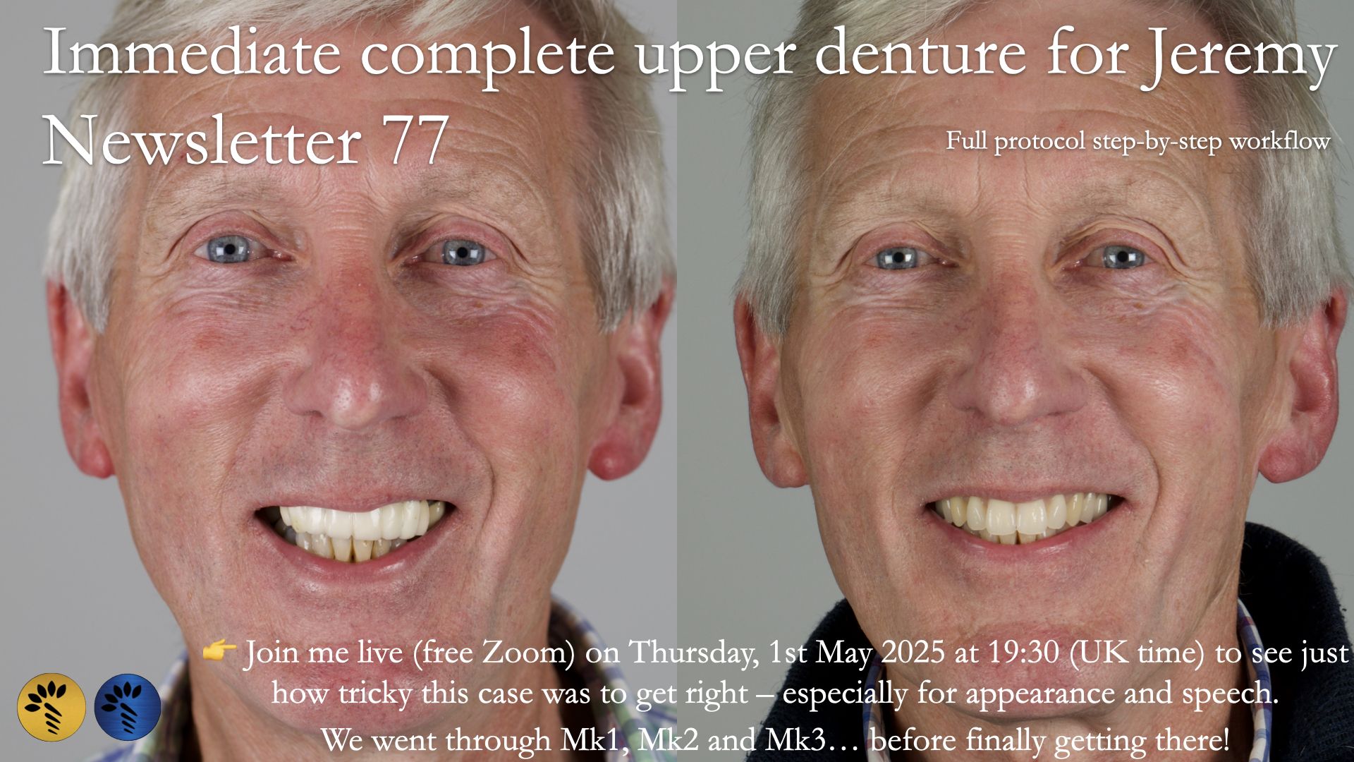 Newsletter 77: Jeremy’s case – immediate complete upper denture