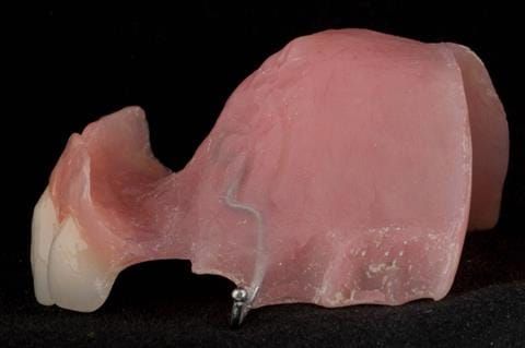 Figure 62. Relined immediate denture with added flange.