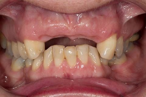 Figure 42. Three months after extractions - ridge remodelling/shrinkage.
