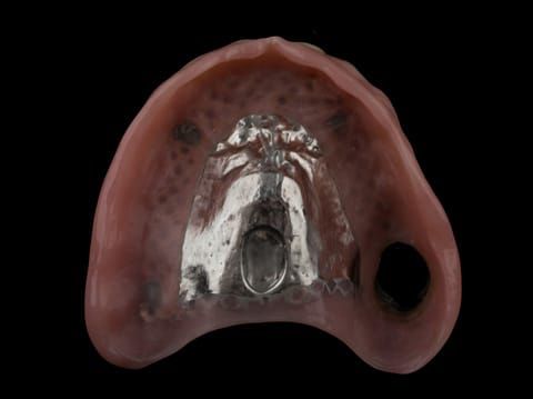 Figure 66. Definitive denture finished with Molloplast B "O" ring around UR7