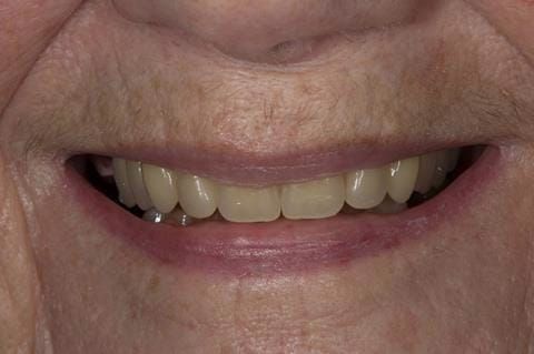 Figure 60. Visit 4 Teeth wax try in with Schottlander Enigmalife teeth in mouth.