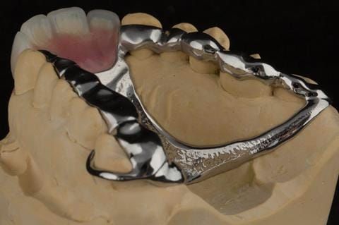 Figure 103. Finished cobalt chromium based maxillary partial showing clearance around the gingival margins