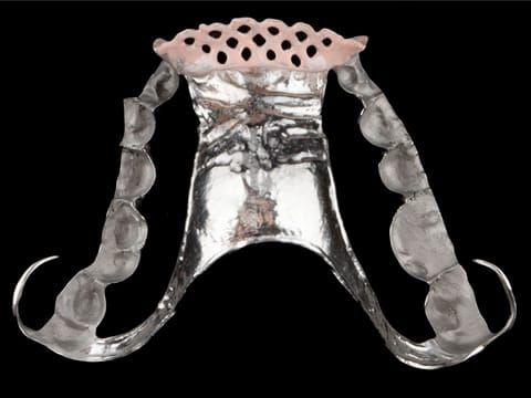 Figure 91. Cobalt chromium framework opaqued for acrylic work, electrolytically polished where it contacts palatal soft tissue for hygiene and unpolished where it touches the teeth to maximise retention. - Chris Hesketh, Bespoke Frameworks, Chorley, UK.