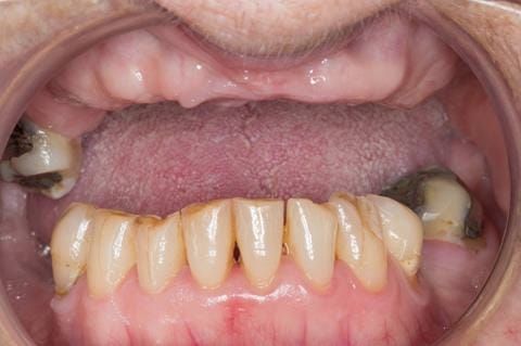 Figure 9. Pre-treatment - irregular mandibular occlusal plane. UR7 - occlusal and buccal amalgam.