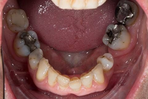 Figure 12. Pre-treatment - occlusal view - lower arch.