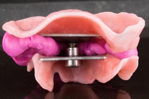 Figure 46. Visit - 3 Central bearing apparatus fixed together with Futar D taken out of the mouth showing pin in countersink hole over apex of the arrow.