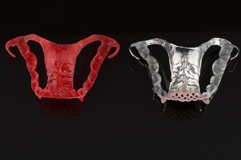 Figure 90. Cobalt chromium framework mimicking the pattern resin prototype - Chris Hesketh, Bespoke Frameworks, Chorley, UK.