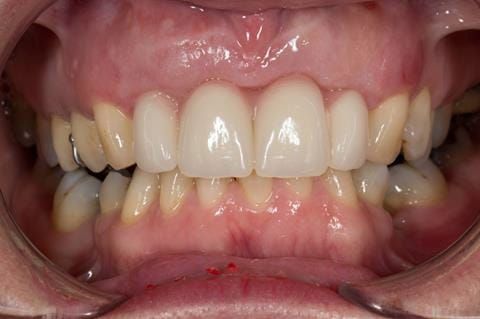 Figure 37. Maxillary immediate denture fitted one week after the extraction appointment. Schottlander Enigmalife teeth.