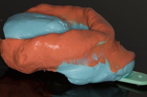 Figure 18. Visit 1. Maxillary primary impression made in two stages using Accudent XD, Ivoclar. This allows full extension to record the sulcus - particularly around the UL7