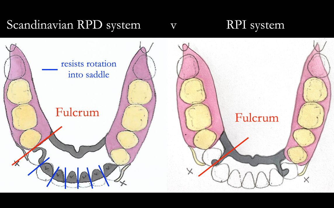 Scandinavian approach versus RPI system demonstrating the engineering advantage of the Scandinavian system.