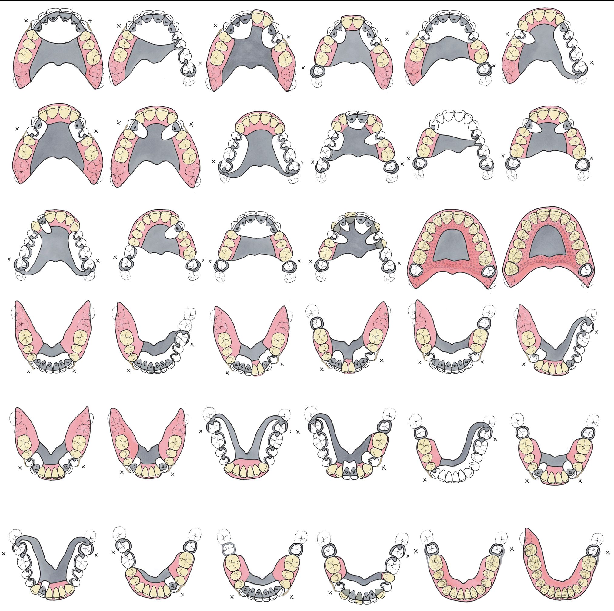 RPD designs for various combinations of missing teeth