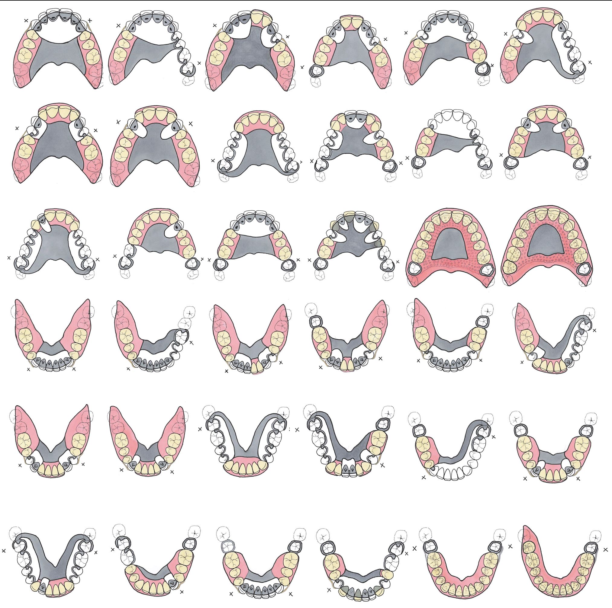 Aide memoire - for various combinations of missing upper teeth ...