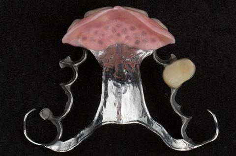 Figure 125. Cobalt chromium based maxillary partial denture from a different case. The upper right first premolar required removal at a later date. Dental bar designed using a laser welded tag to support the artificial tooth.