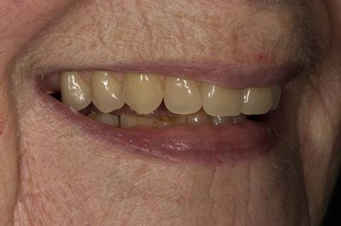 Figure 81. Visit 5 Fitted definitive denture - Schottlander Enigmalife teeth