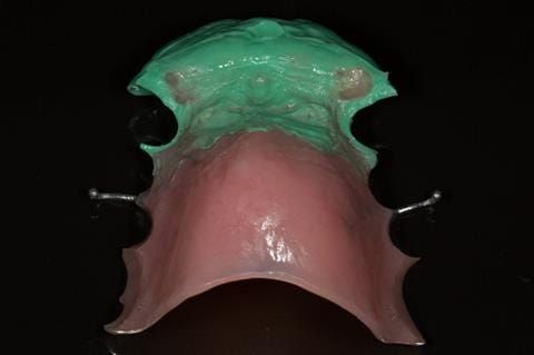 Figure 53. Immediate denture laboratory reline - part 1 with light bodied silicone impression material (Doric Flo light - Schottlander).