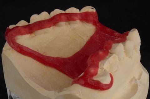Figure 85. Pattern resin framework prototype of the cobalt chromium connectors to verify fit and occlusal relation - showing clearance around the gingival margins.