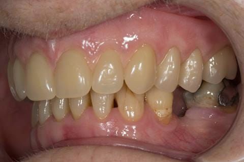 Figure 78. Visit 5 Fitted definitive denture - Schottlander Enigmalife teeth