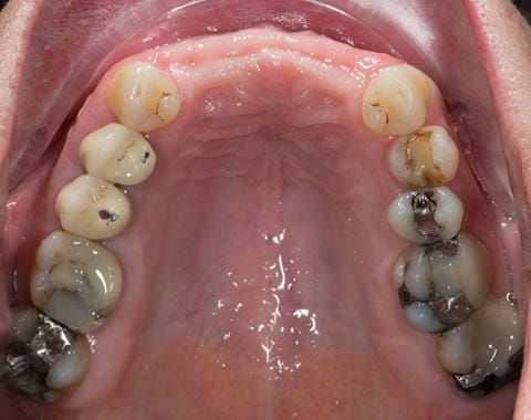 Figure 73. Edentulous ridge 11 months post extraction. Ready to start making definitive cobalt chromium based partial denture.